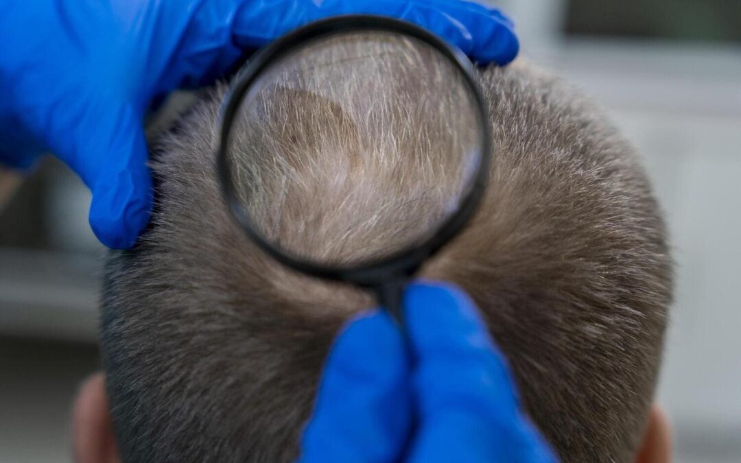 Tipos de alopecia: cuáles son, causas y tratamiento