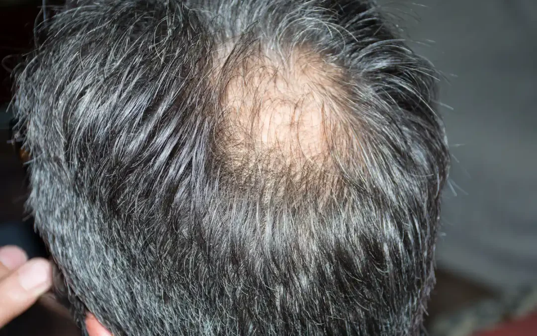 Alopecia areata: qué es, por qué aparece y cómo se trata