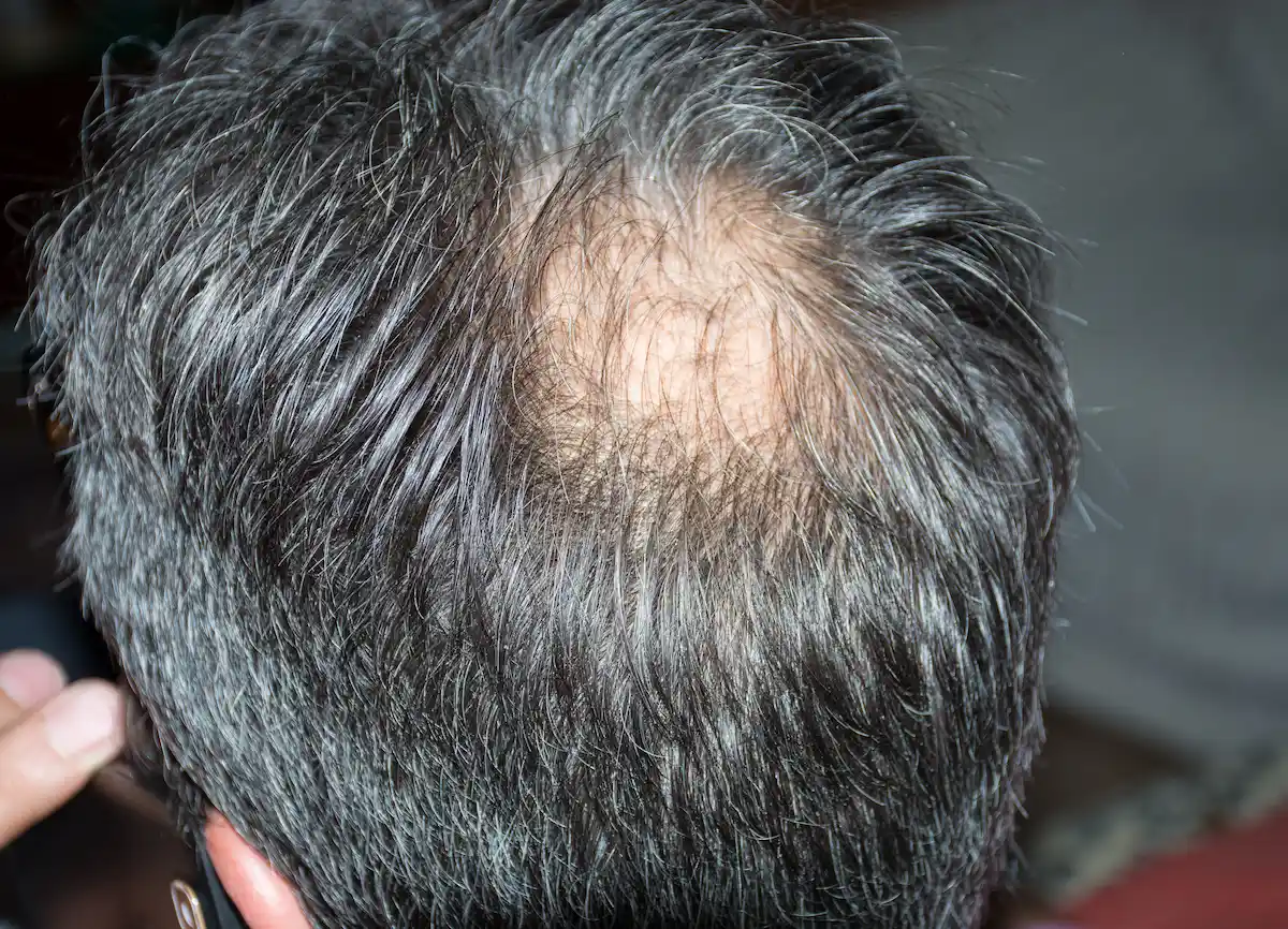 tratamientos de la alopecia areata