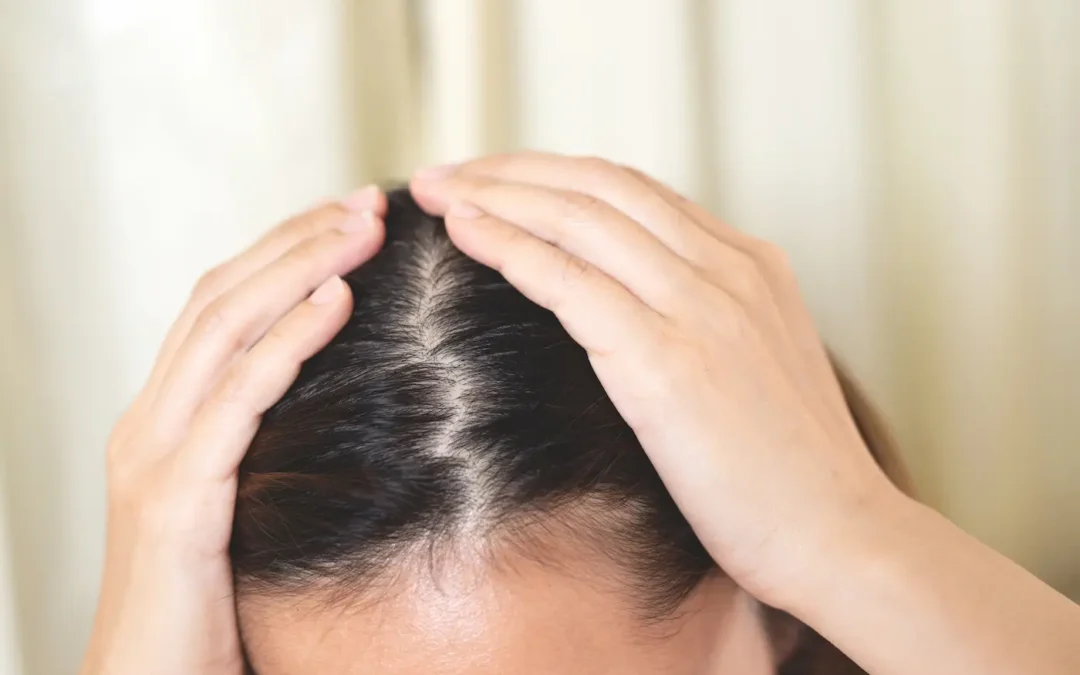 Alopecia androgénica en mujeres