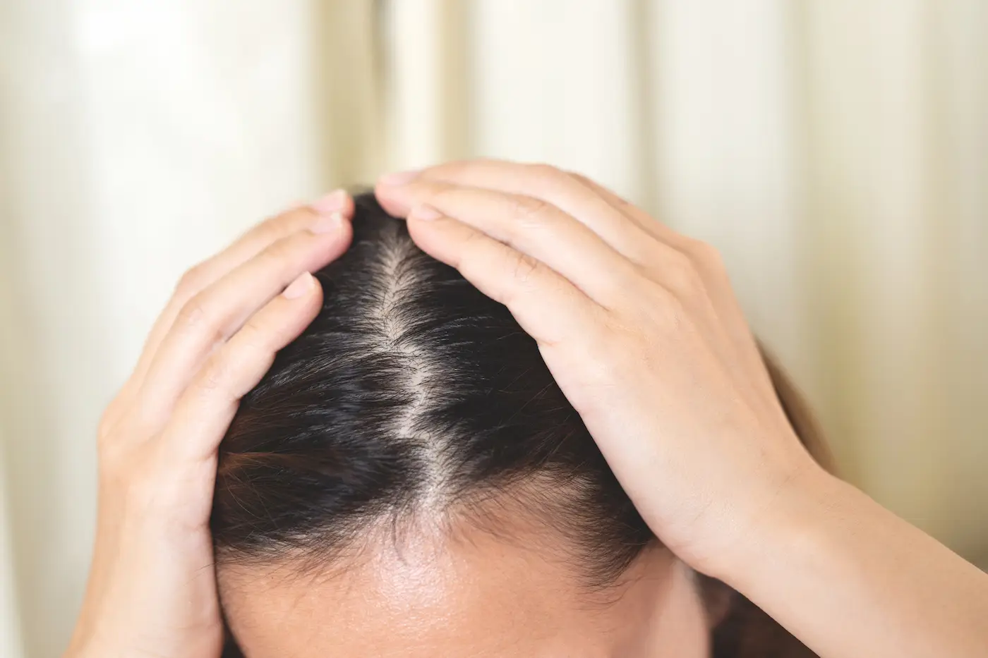 alopecia androgénica en mujeres