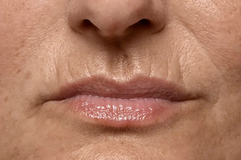 tratamiento facial en Málaga arrugas código de barras