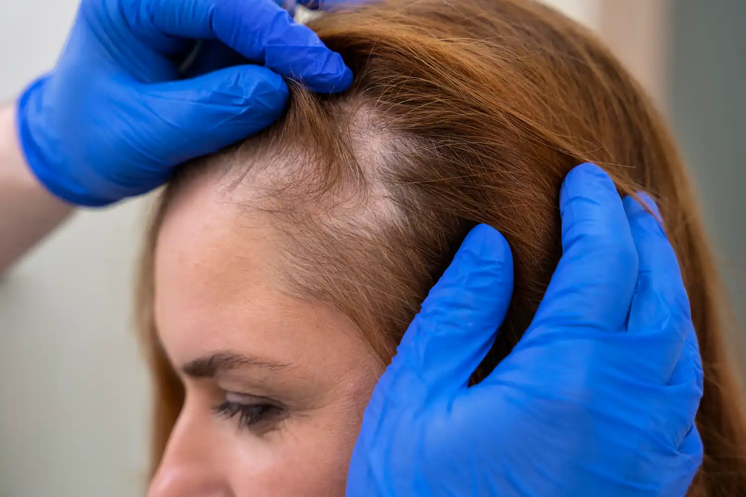 alopecia traumática
