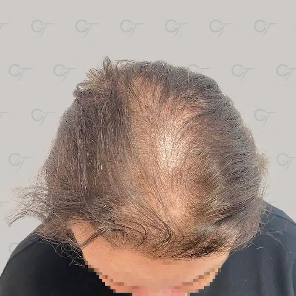 Antes
