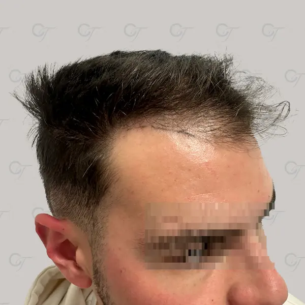 Antes