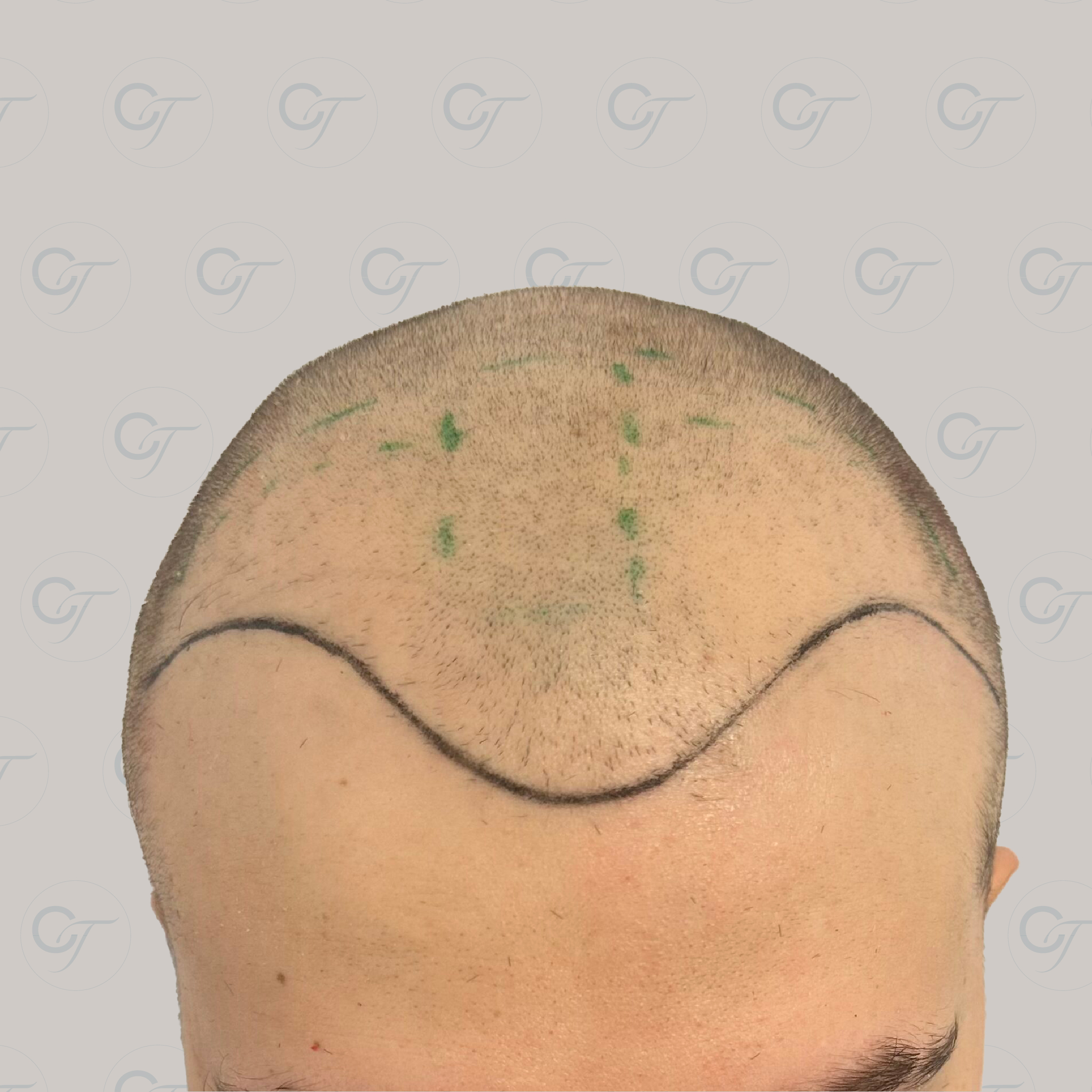 Antes