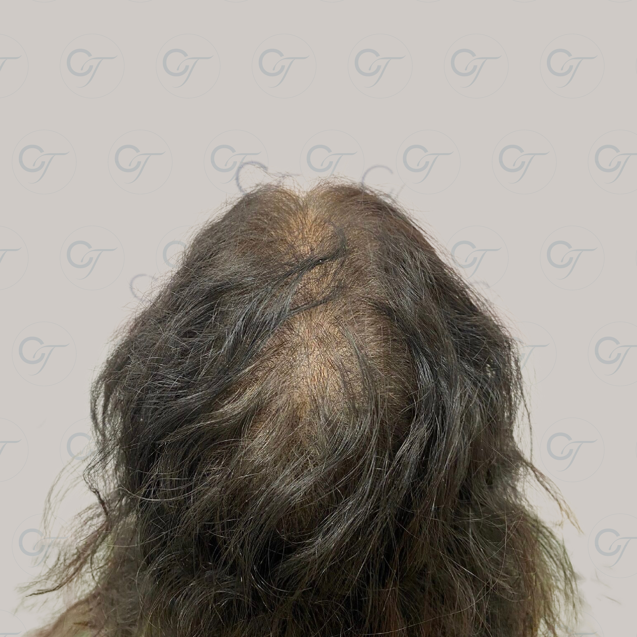 Antes