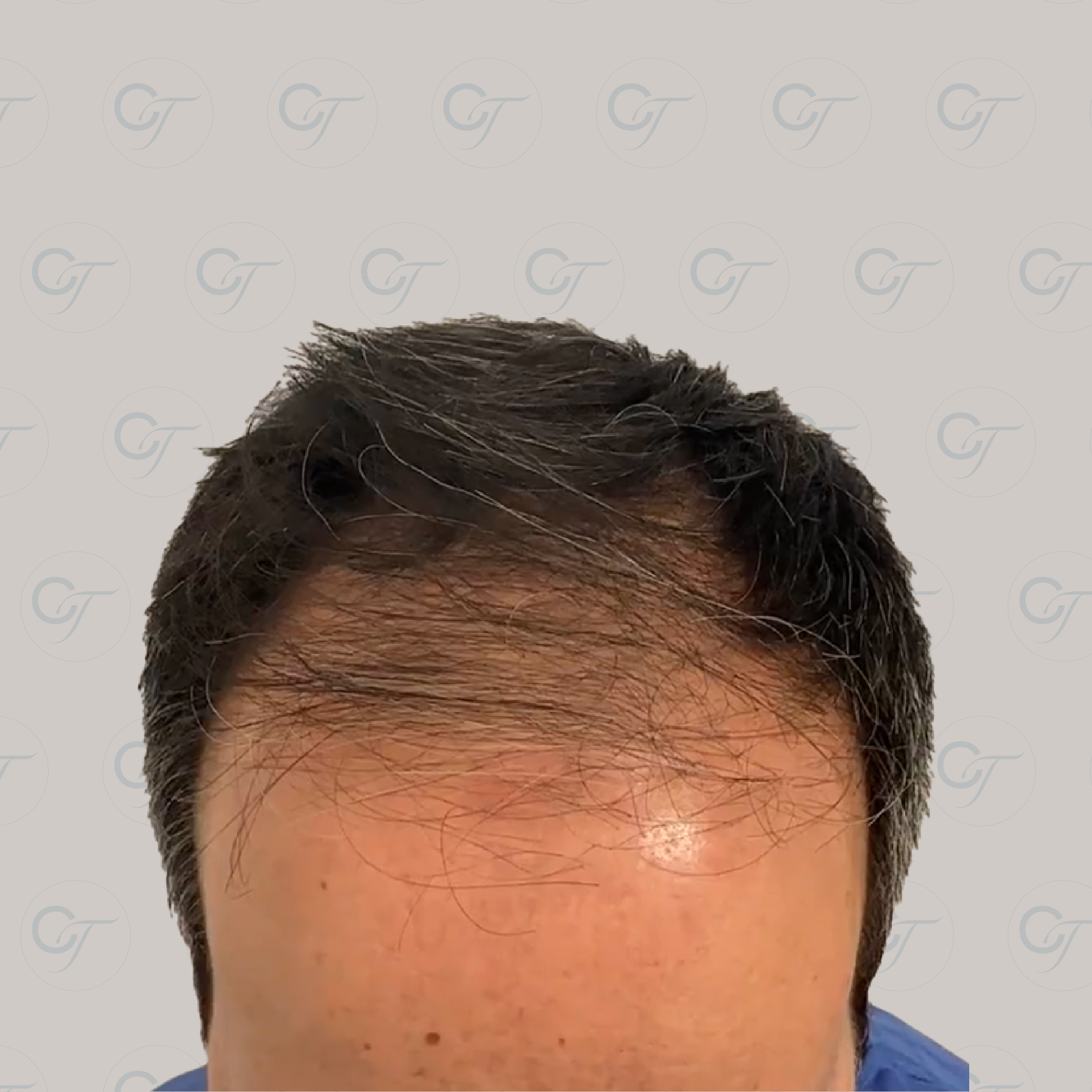 Antes