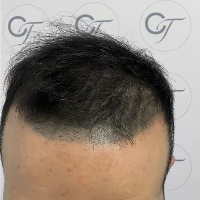 Antes