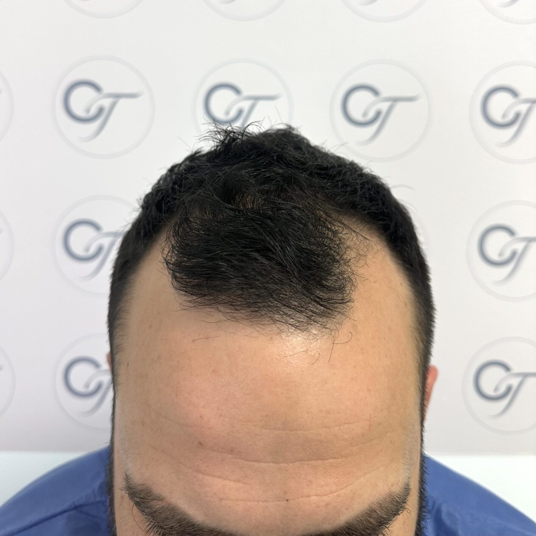Antes