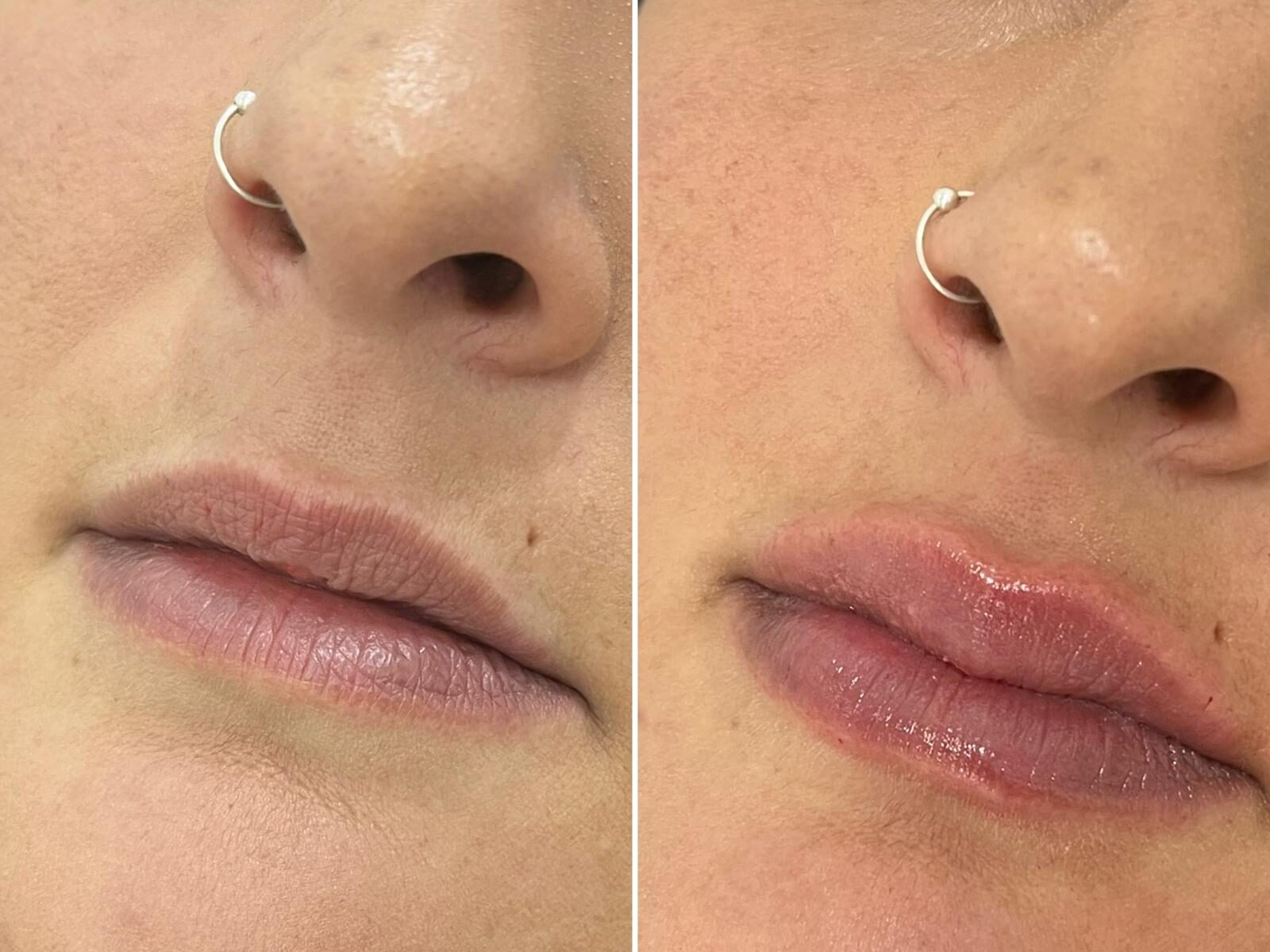 aumento de labios