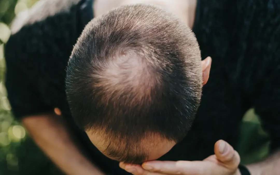 Alopecia por estrés: qué es, síntomas y cómo tratarla