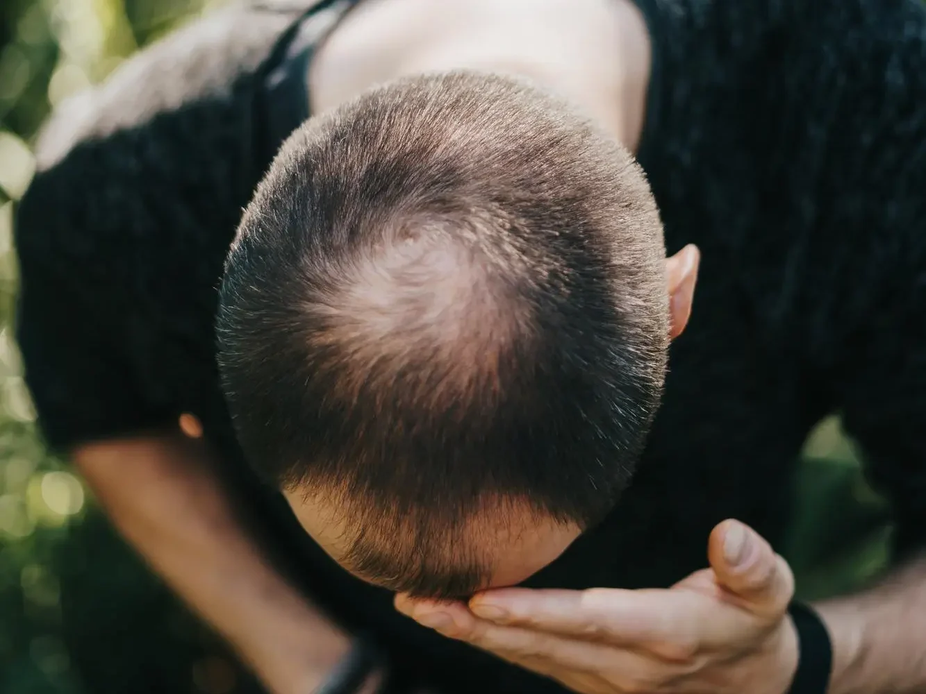 alopecia por estres